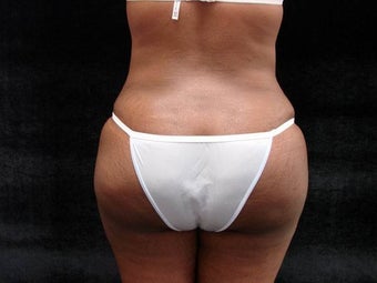 Brazilian Butt Lift