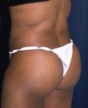 Brazilian Butt Lift (Butt Augmentation)