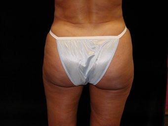 Brazilian Buttocks Lift
