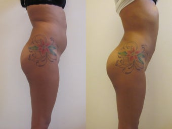 Brazilian butt lift