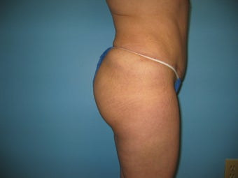 buttock augmentation (Brazilian buttock lift)