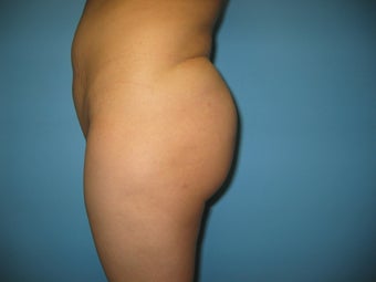 buttock augmentation (Brazilian buttock lift)