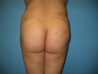 buttock augmentation (Brazilian buttock lift)
