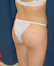 Brazilian Butt Lift 
