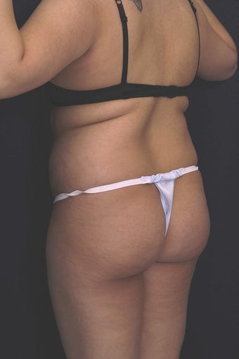 Fat injections to buttocks for Brazilian Butt Lift