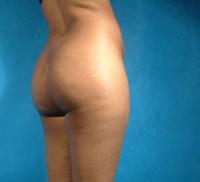 Brazilian Buttock Lift