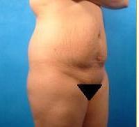 Brazilian Buttock Lift