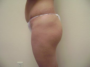 Brazilian Butt Lifts
