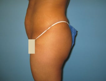 Buttock augmentation (Brazilian buttock lift)