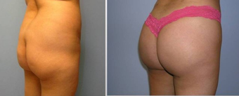 Brazilian Butt Lift