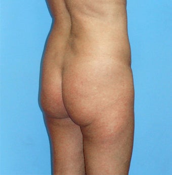 Brazilian Butt Lift