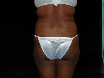 Brazilian Butt Lift