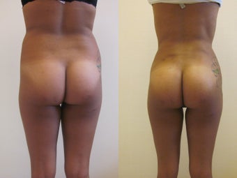 Brazilian butt lift