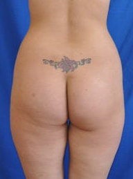 Brazilian Butt Lift