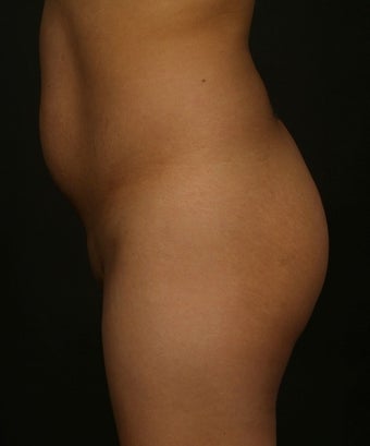 Brazilian Butt Lift
