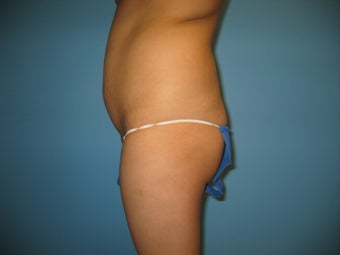 buttock augmentation (Brazilian buttock lift)