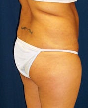 Brazilian Butt Lift