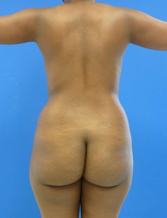 Brazilian Butt Lift - via Fat transfer