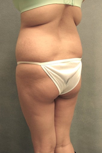 Brazilian Buttock Lift