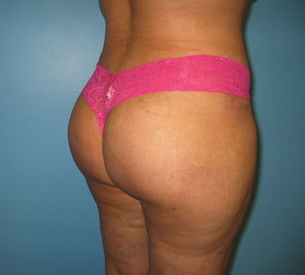 Buttock augmentation (Brazilian buttock lift)