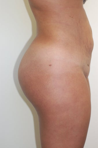 Brazilian Buttock lift