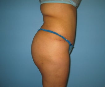 buttock augmentation (Brazilian buttock lift)