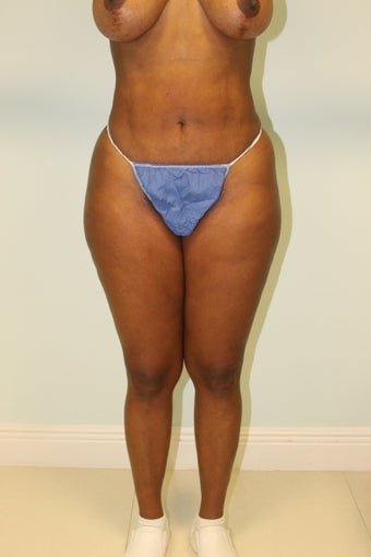 Brazilian that lift