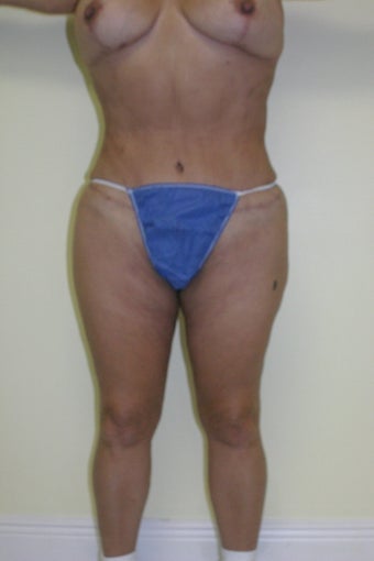 Brazilian butt lift