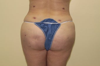 Brazilian butt lift
