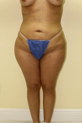 Brazilian butt lift