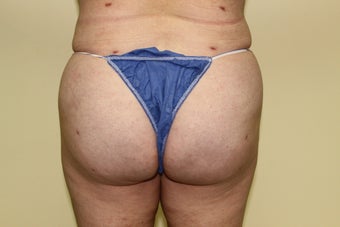 Brazilian butt lift
