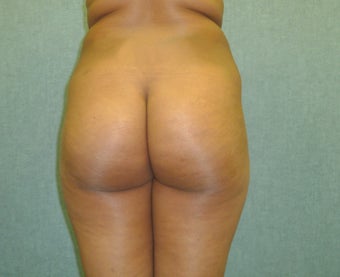 Brazilian Butt Lift