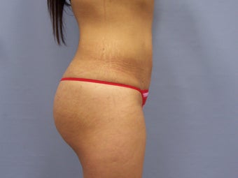 Brazilian Butt-lift