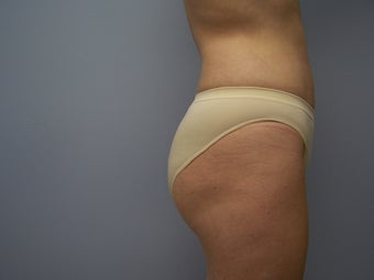 Brazilian Butt-lift