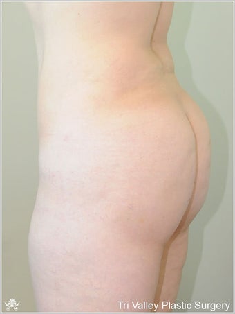  Brazilian buttock lift