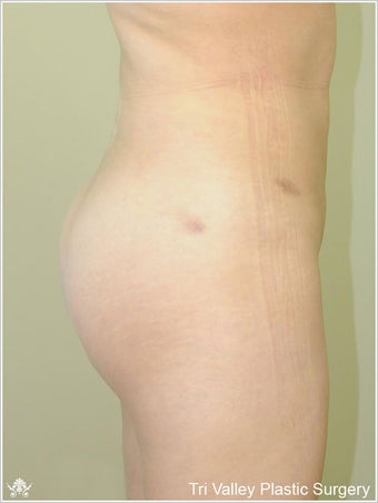  Brazilian Buttock Lift