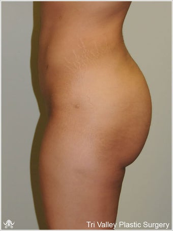  Brazilian Buttock Lift