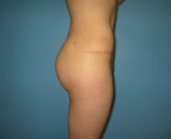 Brazilian buttock lift