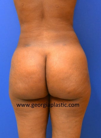 Brazilian Buttock Lift