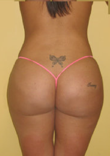 Buttock Augmentation