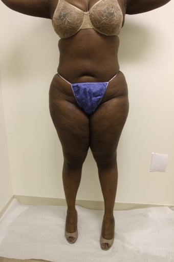 Brazilian Butt Lift