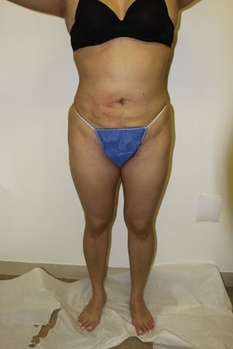 Brazilian Butt Lift
