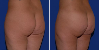 Brazilian Butt Lift