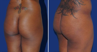 Brazilian Butt Lift