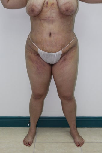 Brazilian Butt Lift
