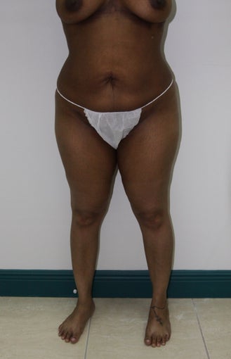 Brazilian Butt Lift
