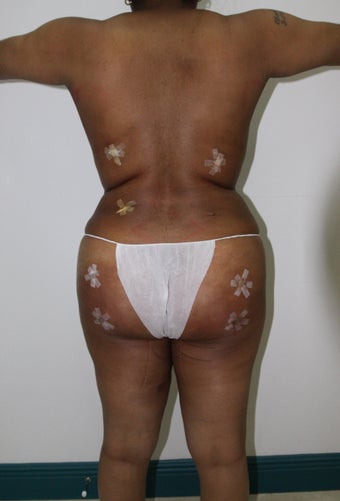 Brazilian Butt Lift