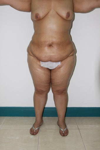 Brazilian Butt Lift