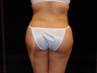 Buttocks Augmentation