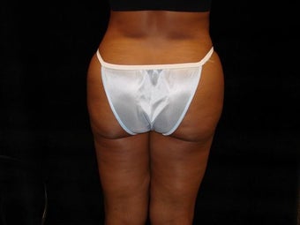 Buttocks Augmentation